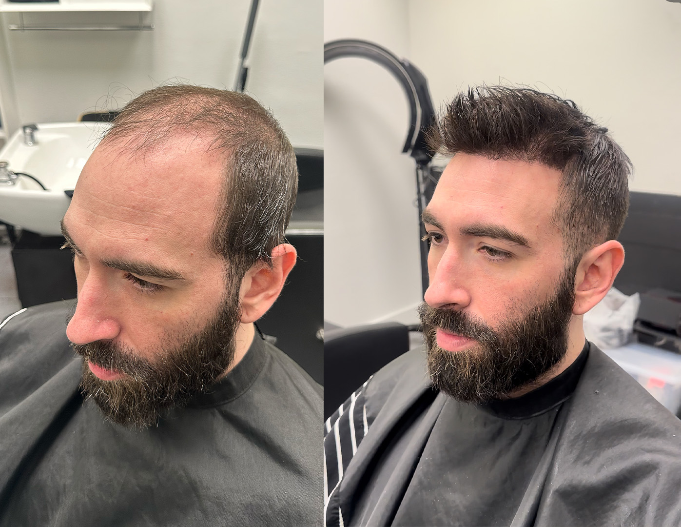 Before-and-after men's hair system transformation in Kansas City