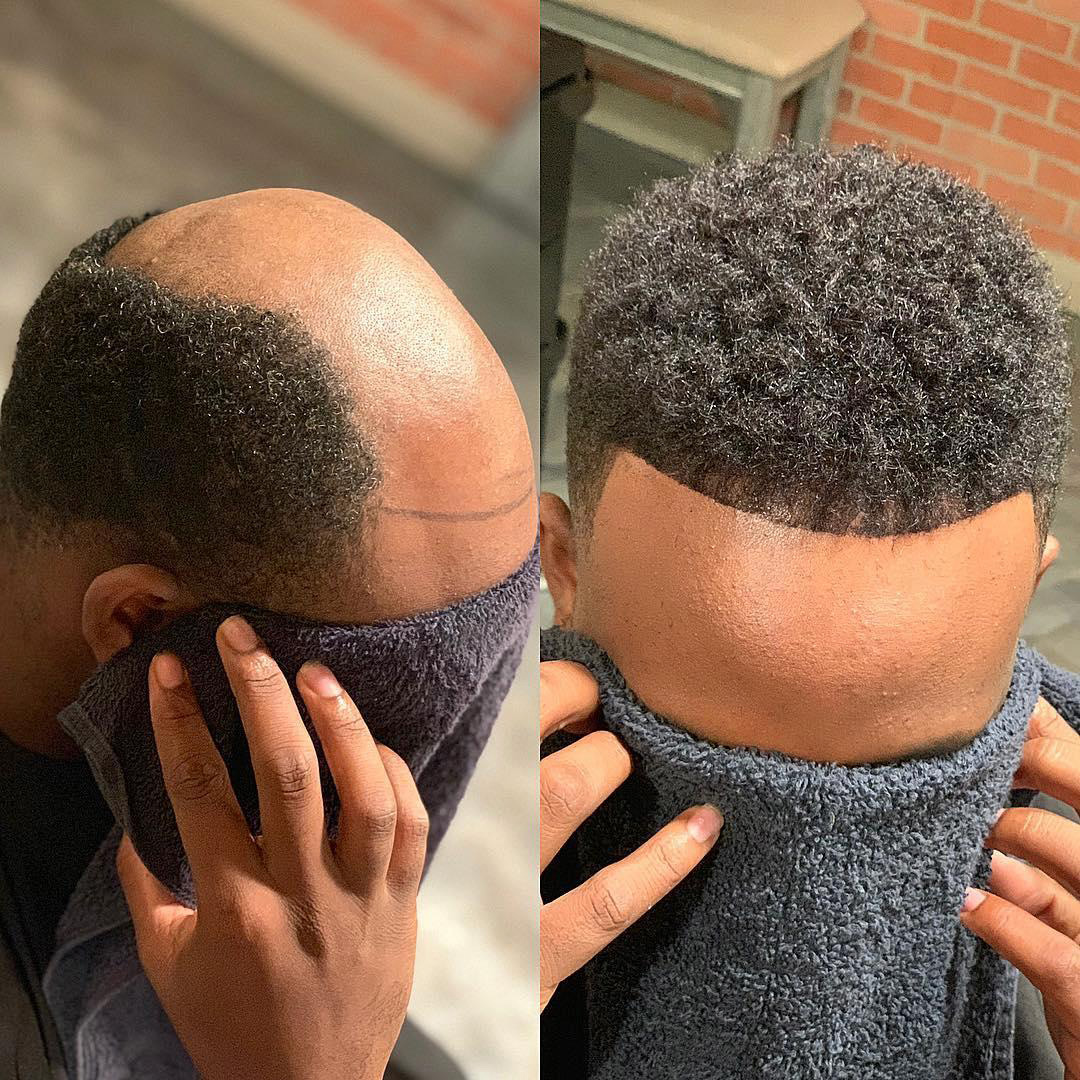 Men's hair system transformation in Kansas City Before-and-after men's hair system transformation in Kansas City