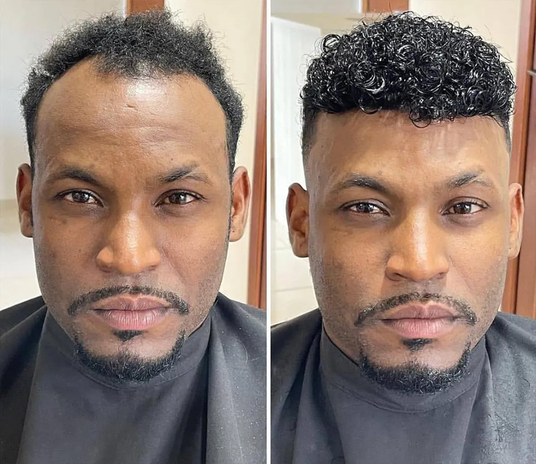 Men's hair unit result in Kansas City Before-and-after men's hair unit result in Kansas City